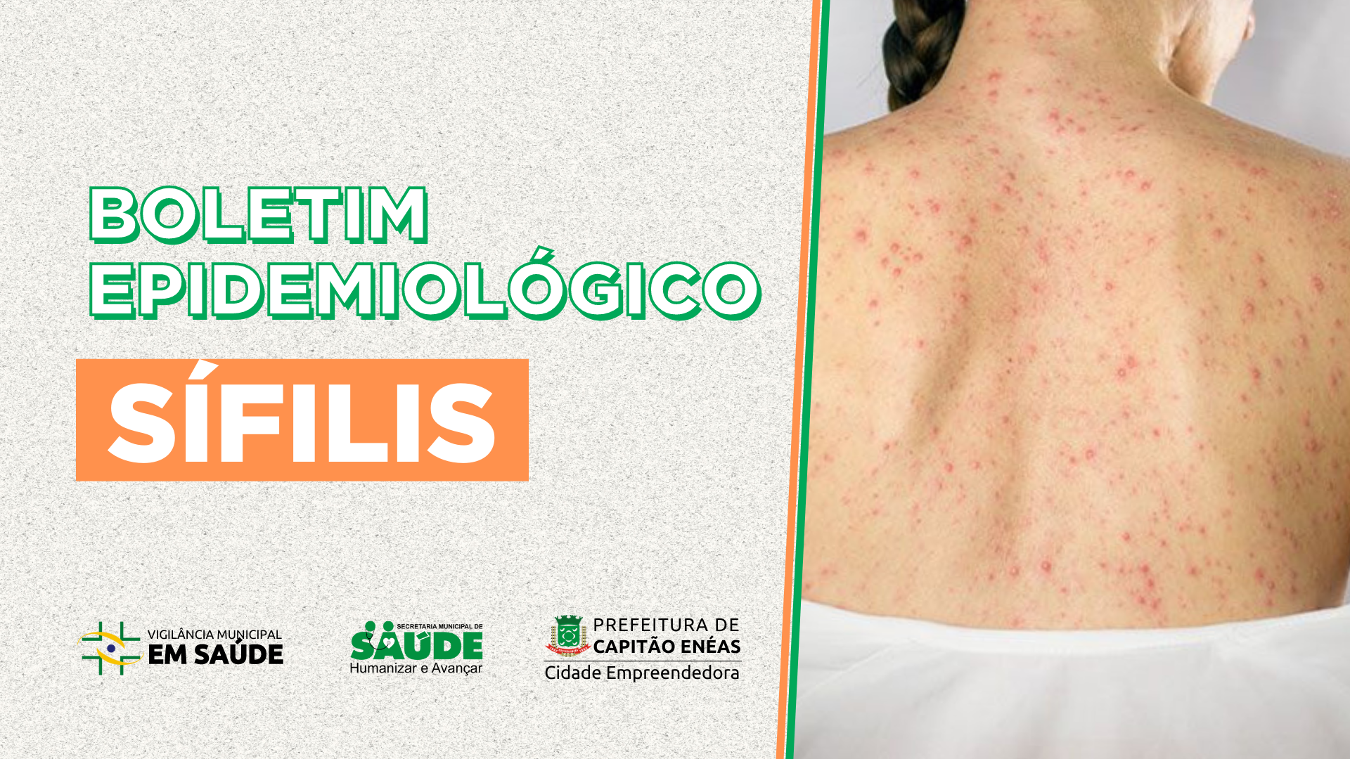 BOLETIM EPIDEMIOLÓGICO – SÍFILIS